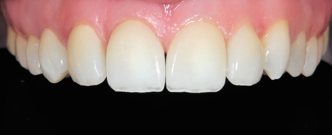 Teeth Straightening, Sculpting and Composite Bonding After