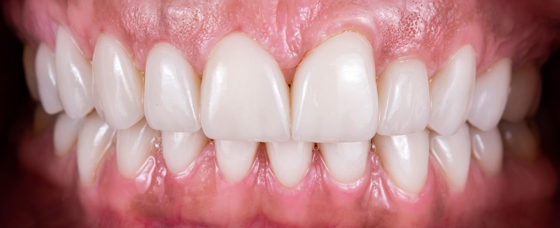 Crowns and Veneers After