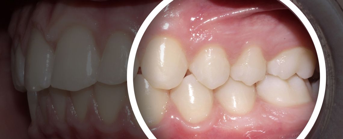 Bite Concerns Teeth Straightening After