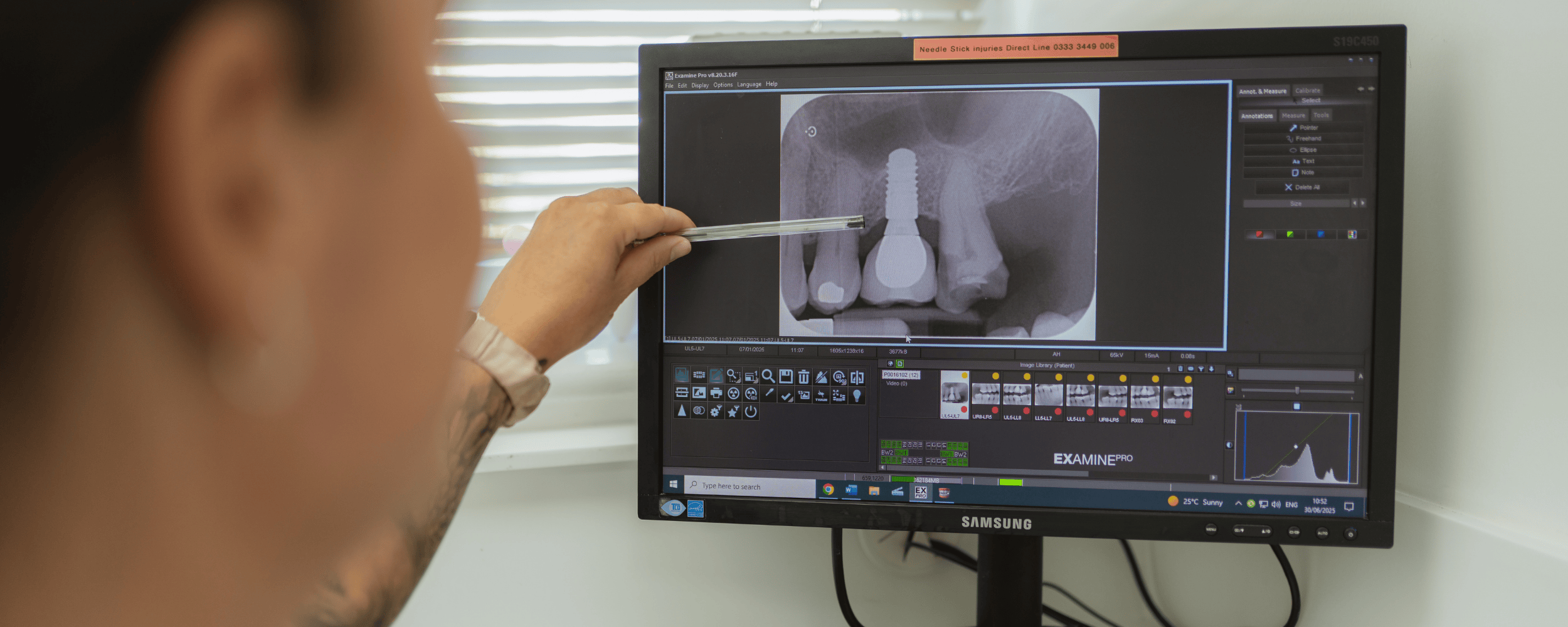 Dental implant journey
