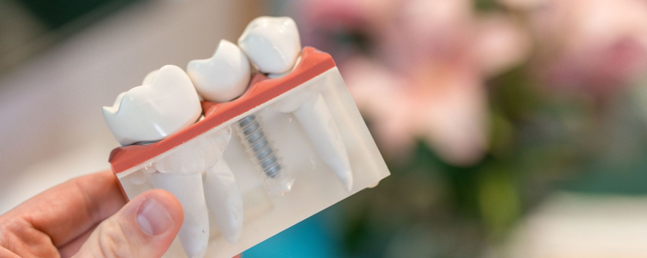 Single tooth dental implants